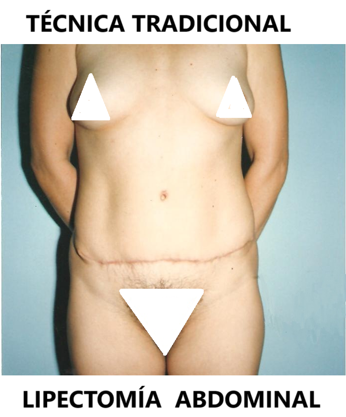 Lipectomía Abdominal Clásica